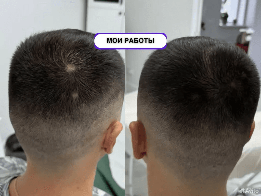 Трихопигментация макушки: до и после